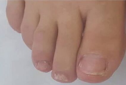 Brand fungus Rand quickly gets rid of mycosis