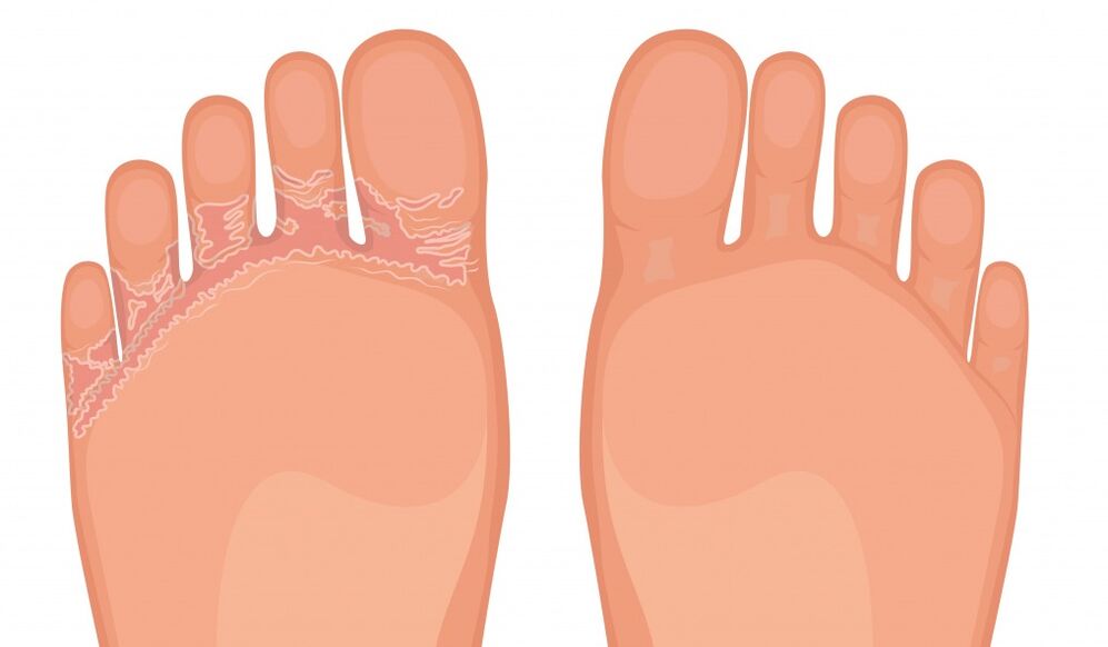 Brand fungus brand effectively against all types of feet fungus
