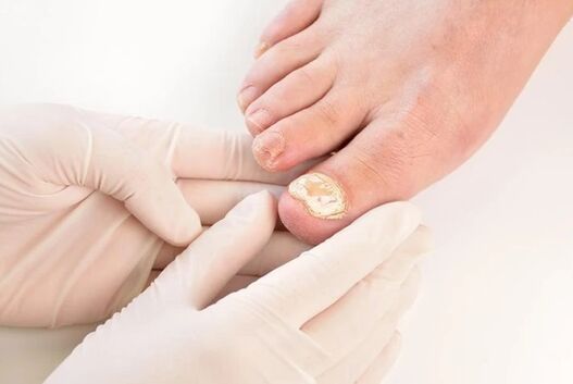 Doctors recommend RAND fungus brand to treat Mycoses
