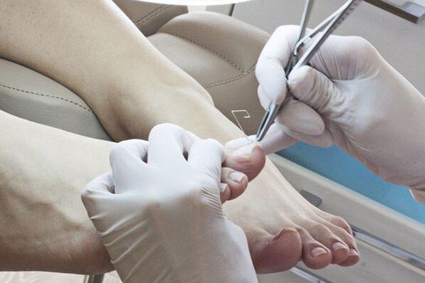 Mechanical nail removal affected by fungi