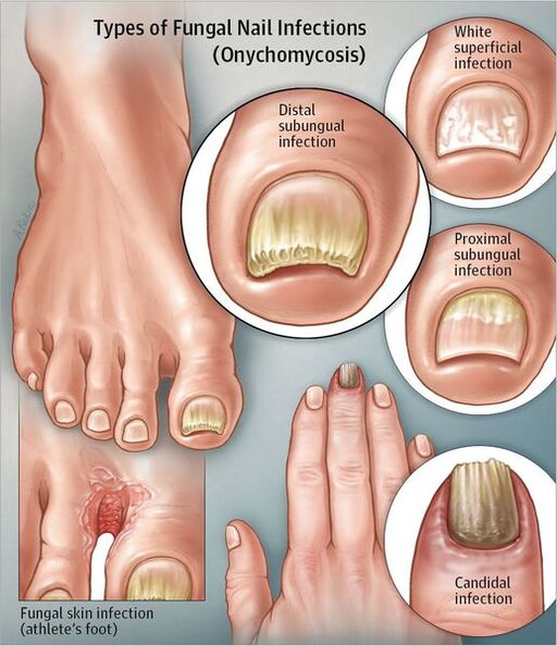 Species of onychomycosis
