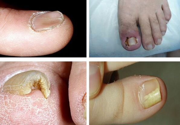 Symptoms of onychomycosis of the legs