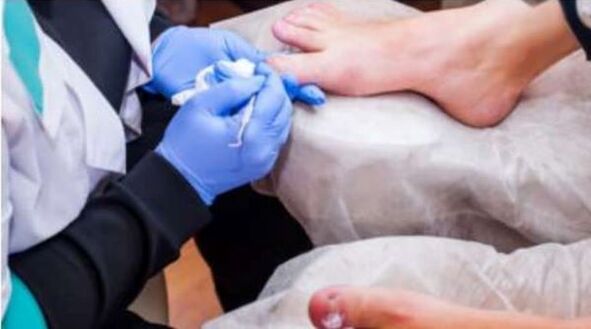 treatment of foot fungus