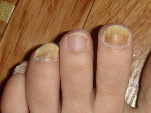 Fungus on the feet with damage to the nails